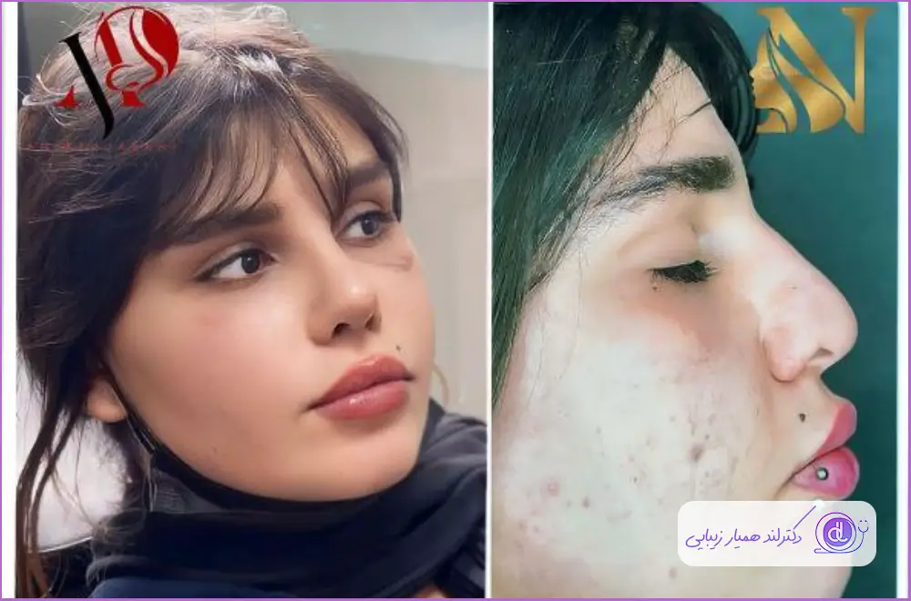 قبل و بعد جراحی زیبایی بینی دخترانه دکتر لطفعلی نوروزی