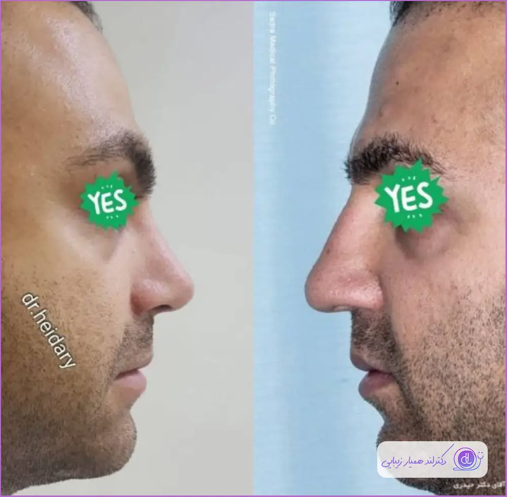 قبل و بعد عمل بینی مردانه دکتر مسعود حیدری