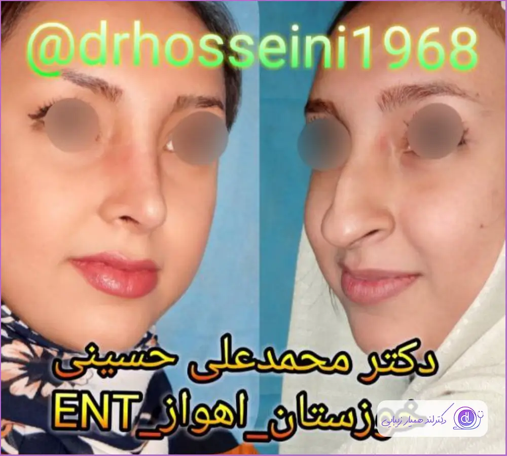کوچک کردن بینی زنانه به سبک طبیعی دکتر محمدعلی حسینی