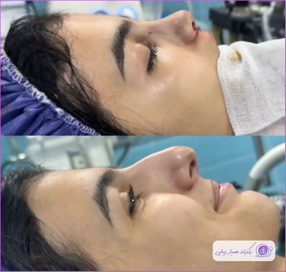 نمونه قبل و بعد جراحی بینی گوشتی به روش باز دکتر رضوان روحی