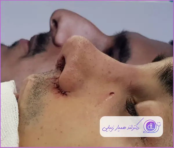 قبل و بعد عمل زیبایی دماغ استخوانی نیمه فانتزی مردانه دکتر صاحب حسینی نژاد