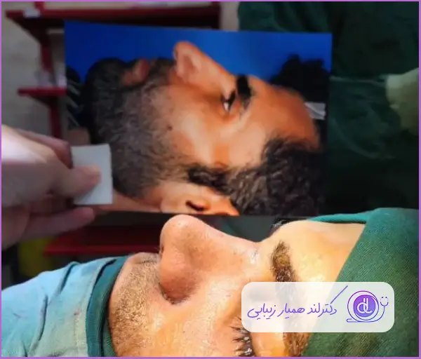 قبل و بعد عمل جراحی دماغ استخوانی طبیعی مردانه دکتر صاحب حسینی نژاد