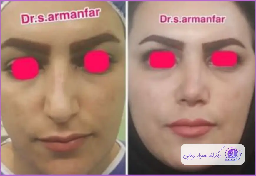 اصلاح فرم بینی زنانه با تکنیک طبیعی دکتر سجاد آرمان فر