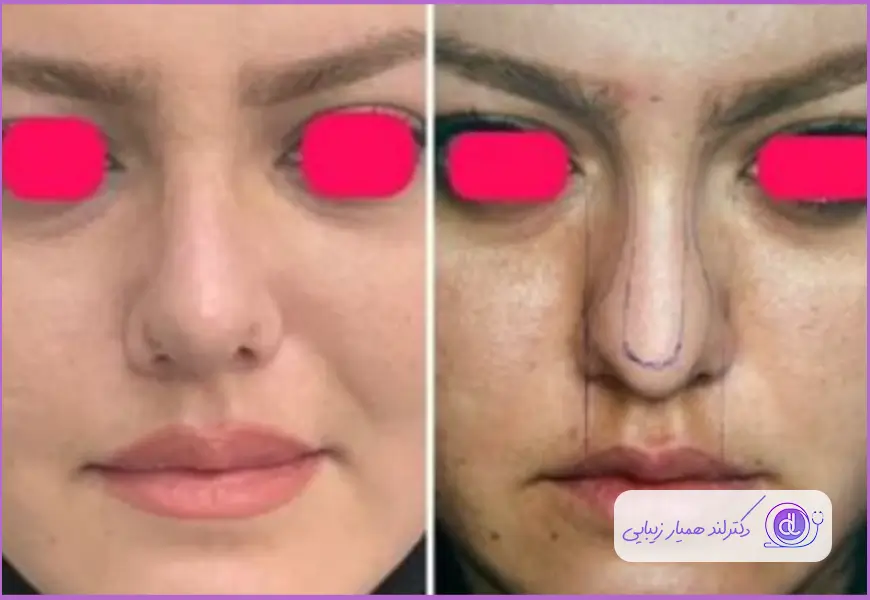قبل و بعد جراحی بینی زنانه و از بین بردن افتادگی بینی به سبک طبیعی دکتر سجاد آرمان فر
