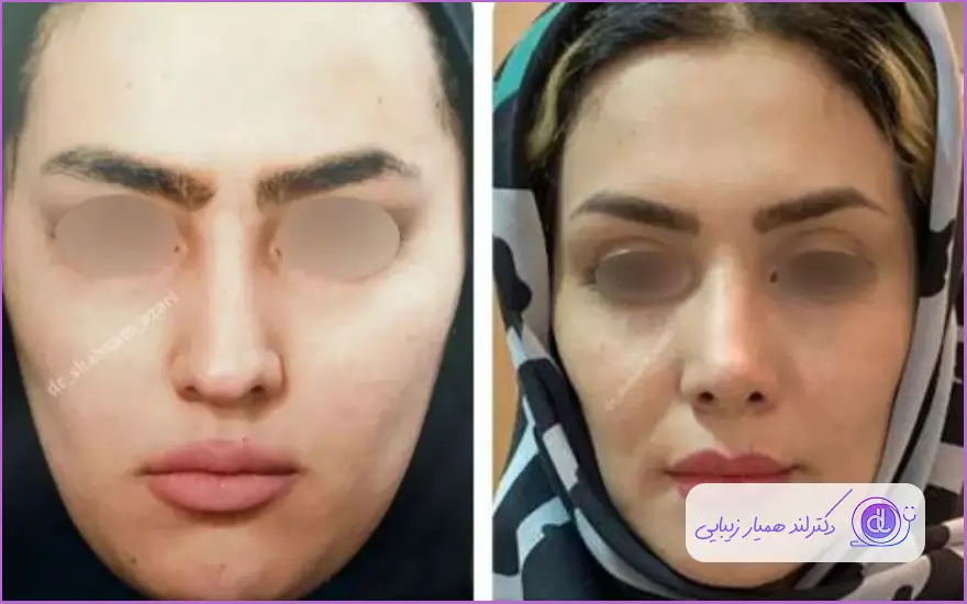 نمونه جراحی زیبایی بینی مدل نیمه فانتزی دکتر شبنم آذری