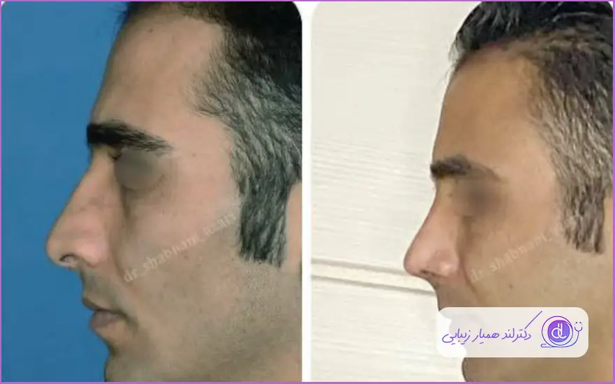 عمل زیبایی بینی مردانه دکتر شبنم آذری