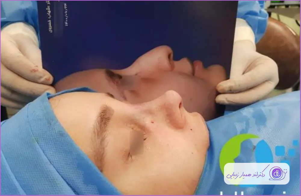 نمونه کار جراحی بینی با تکنیک فانتزی دکتر شهاب خسروی