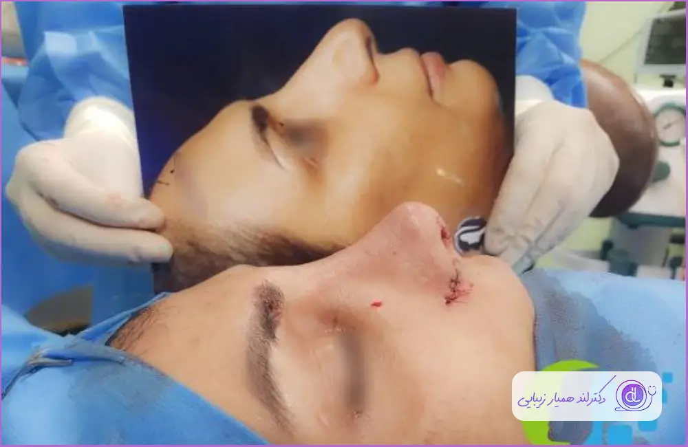 کوچک سازی بینی استخوانی با تکنیک فانتزی دکتر شهاب خسروی