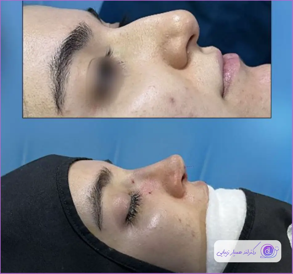 نمونه کار عمل جراحی بینی زنانه دکتر شاهین بنایی
