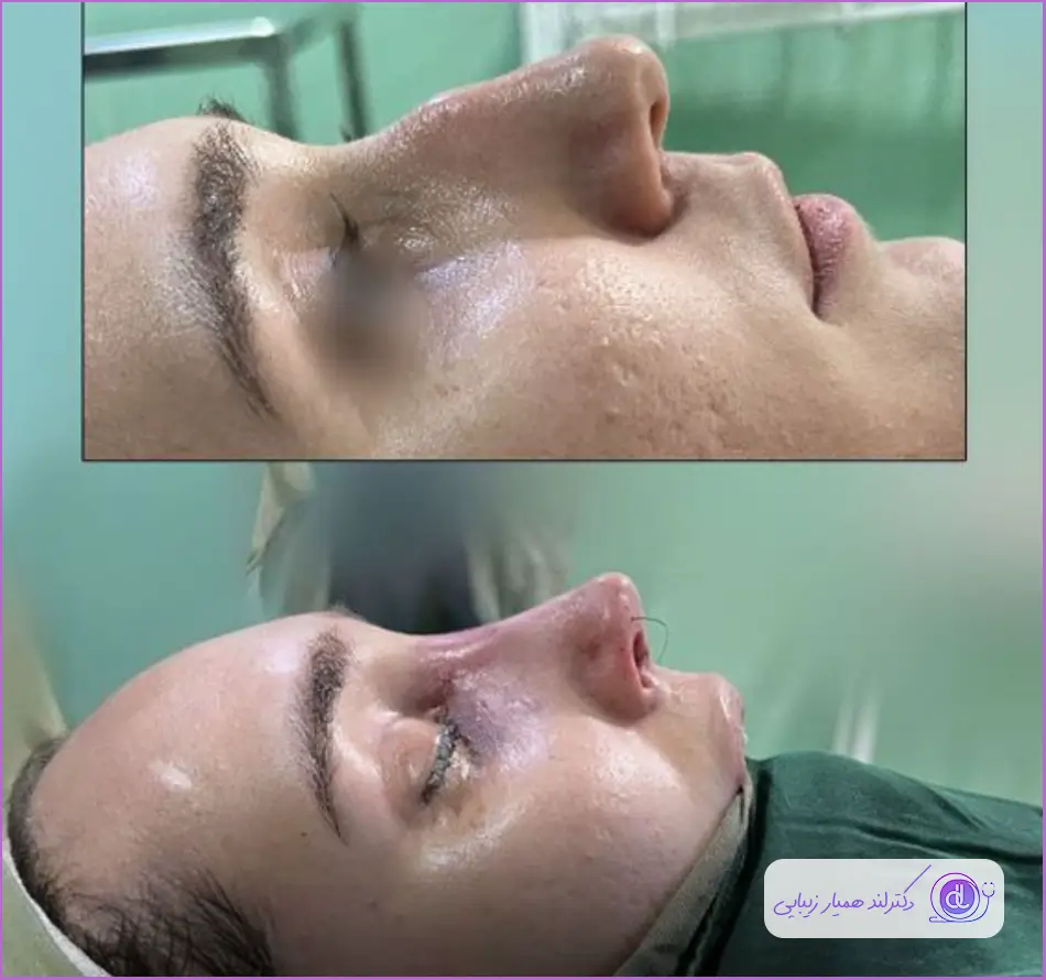 جراحی زیبایی دماغ زنانه با تکنیک بسته دکتر شاهین بنایی
