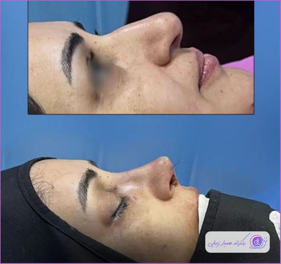 قبل و بعد جراحی زیبایی بینی گوشتی به روش بسته دکتر شاهین بنایی