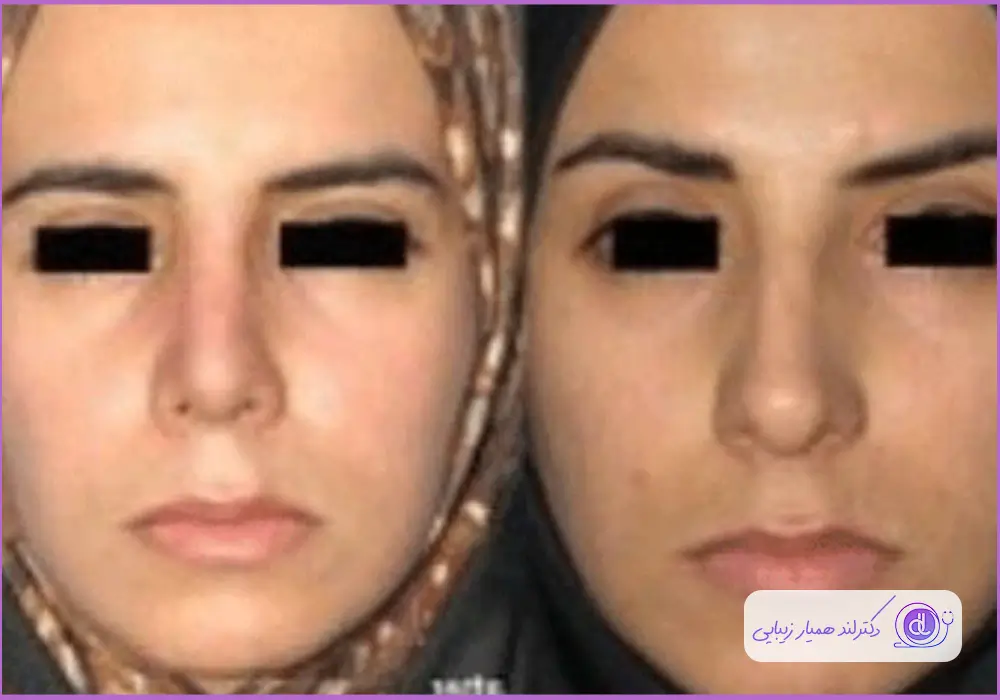 نمونه کار قبل و بعد جراحی زنانه با مدل طبیعی دکتر شهرام فاضلی