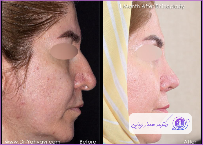 قبل و بعد جراحی رینوپلاستی بینی استخوانی طبیعی زنانه دکتر شهریار یهیوی