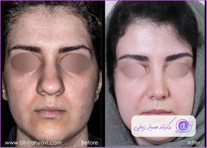 تغییرات جراحی زیبایی بینی گوشتی طبیعی زنانه دکتر شهریار یهیوی