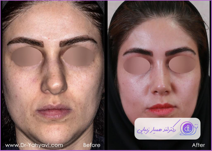 قبل و بعد عمل بینی طبیعی گوشتی
 زنانه دکتر شهریار یهیوی