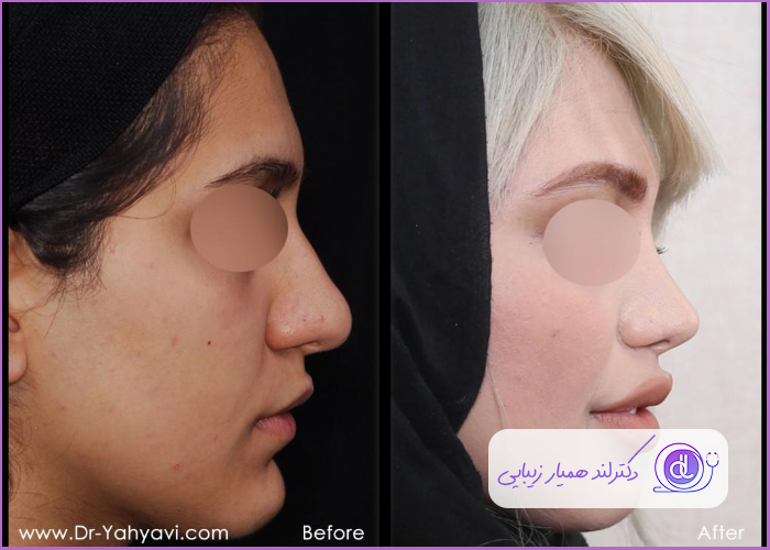 قبل و بعد جراحی بینی گوشتی طبیعی زنانه دکتر شهریار یهیوی