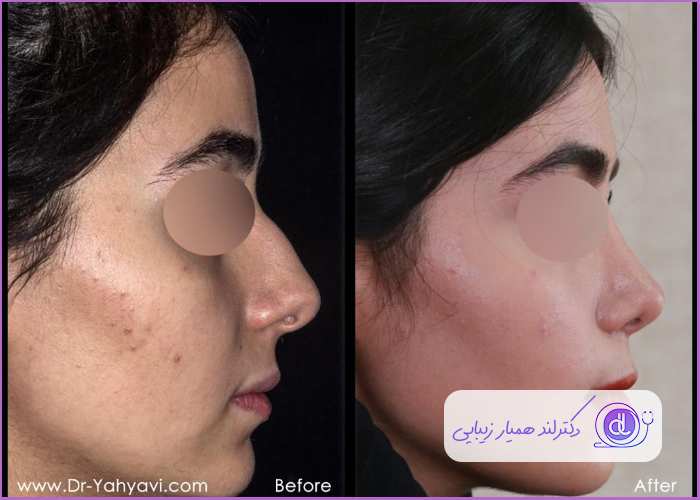 قبل و بعد جراحی بینی استخوانی طبیعی زنانه دکتر شهریار یهیوی