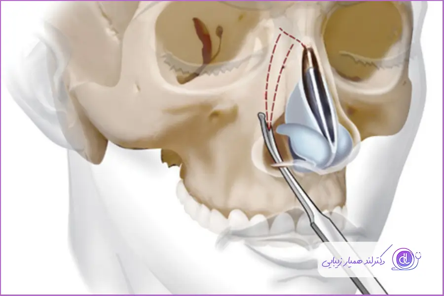  جراحی استئوتومی بینی جانبی