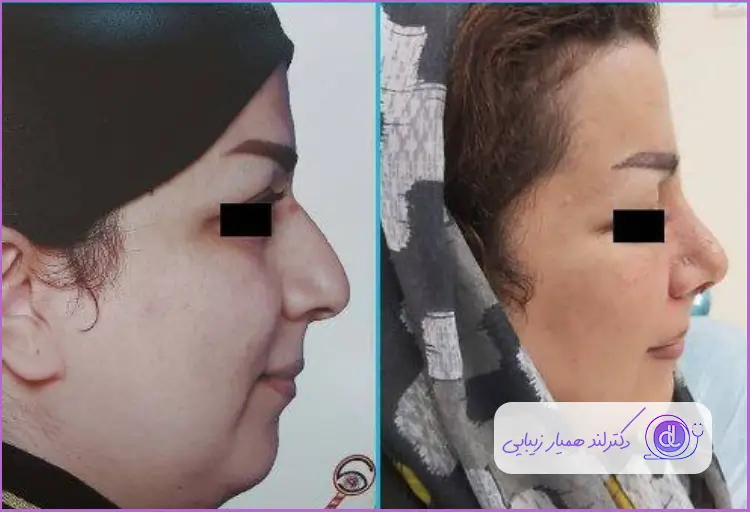 قبل و بعد جراحی بینی استخوانی طبیعی زنانه دکتر علی حسینی واجاری