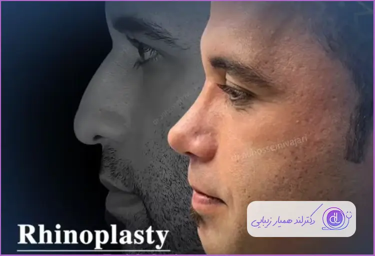 قبل و بعد عمل دماغ استخوانی طبیعی مردانه دکتر علی حسینی واجاری