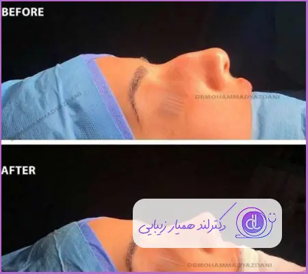 قبل و بعد عمل رینوپلاستی دماغ استخوانی طبیعی زنانه دکتر علی اکبر عطایی
