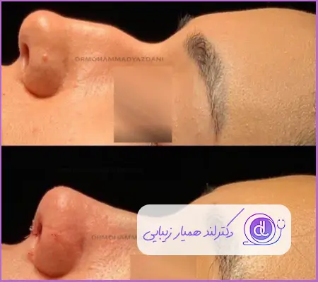 قبل و بعد جراحی بینی استخوانی نیمه فانتزی زنانه دکتر علی اکبر عطایی