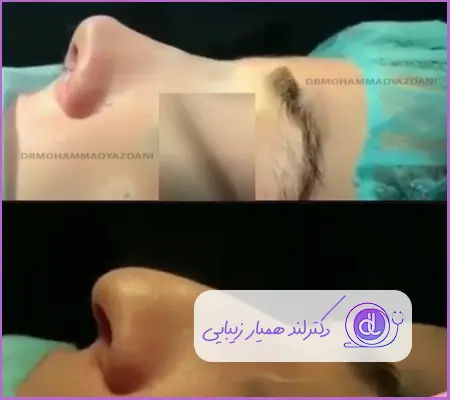 قبل و بعد جراحی بینی استخوانی نیمه فانتزی دخترانه دکتر علی اکبر عطایی