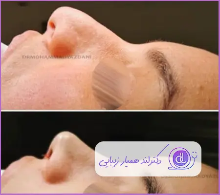 قبل و بعد عمل بینی گوشتی طبیعی زنانه دکتر علی اکبر عطایی