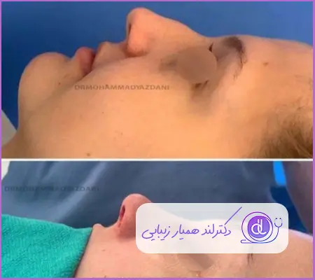 قبل و بعد جراحی زیبایی بینی استخوانی نیمه فانتزی زنانه دکتر علی اکبر عطایی