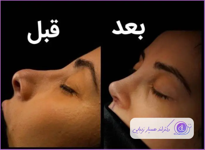 قبل و بعد عمل زیبایی بینی استخوانی طبیعی زنانه دکتر بابک محی