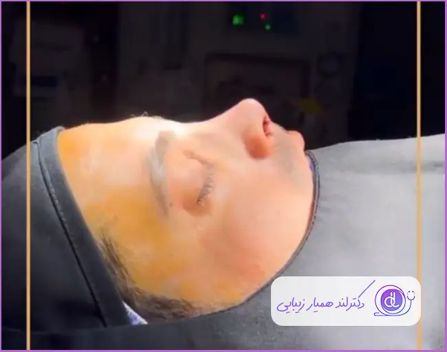 نمونه کار جراحی زیبایی بینی نیمه فانتزی مردانه دکتر احسان شفیعی