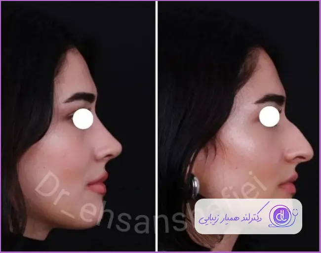 قبل و بعد رینوپلاستی بینی استخوانی طبیعی دخترانه دکتر احسان شفیعی