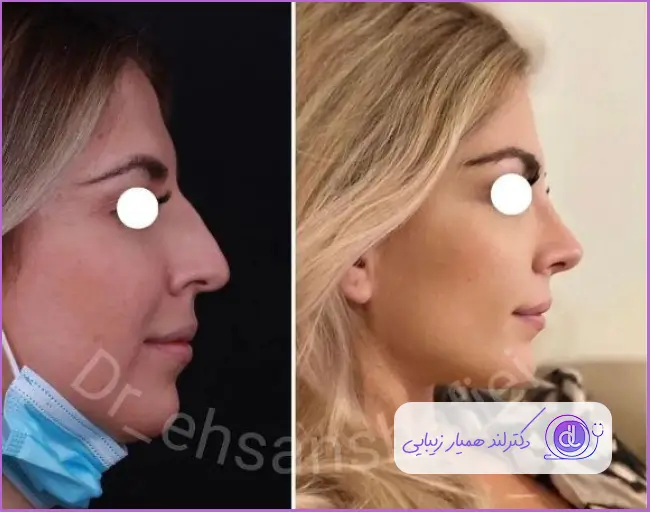 قبل و بعد جراحی زیبایی بینی استخوانی طبیعی زنانه دکتر احسان شفیعی