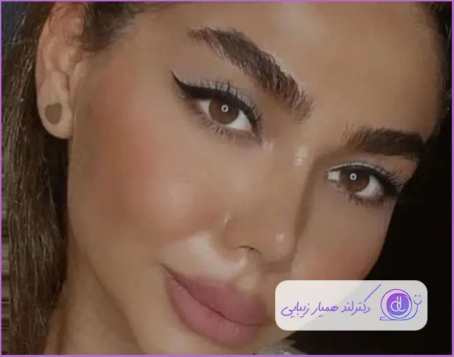 مدل عمل زیبایی بینی نیمه فانتزی دخترانه دکتر احسان شفیعی