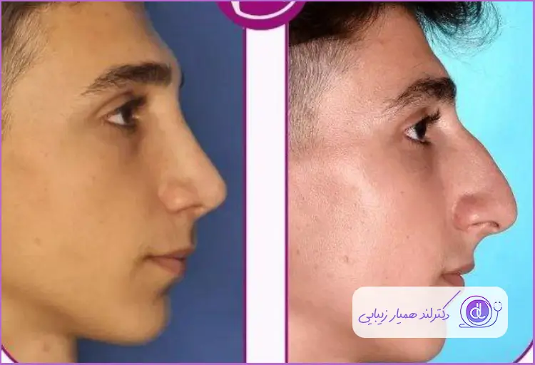 قبل و بعد جراحی بینی استخوانی طبیعی مردانه دکتر فیروزه ضیا