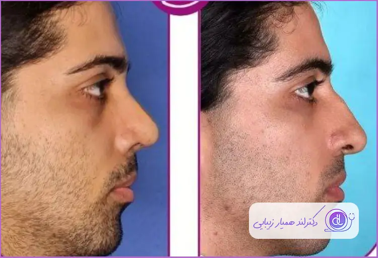 قبل و بعد رینوپلاستی بینی استخوانی طبیعی مردانه دکتر فیروزه ضیا
