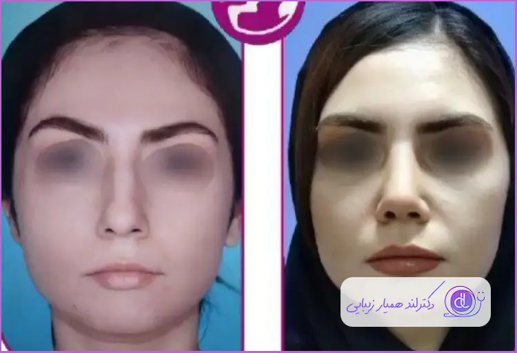 تغییرات جراحی زیبایی بینی به سبک طبیعی دخترانه دکتر فیروزه ضیا