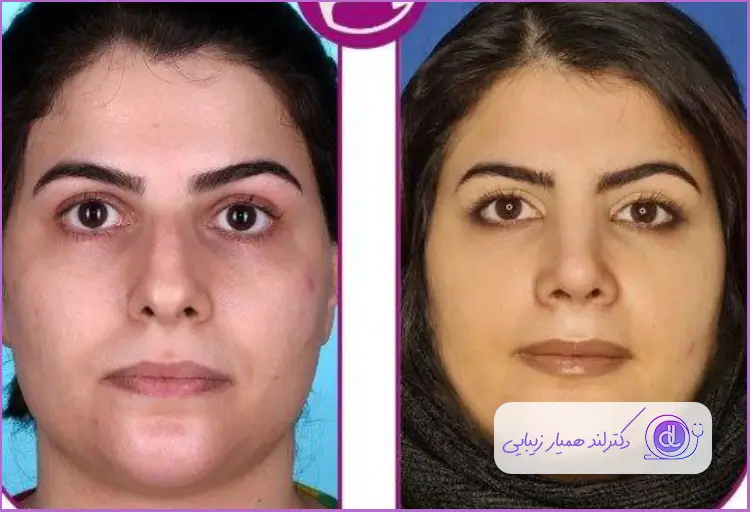 قبل و بعد جراحی بینی به سبک طبیعی زنانه دکتر فیروزه ضیا