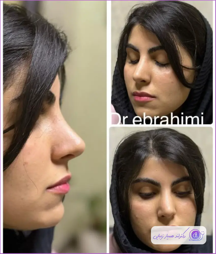 نمونه کار جراحی زیبایی بینی دخترانه دکتر فروغ ابراهیمی نژاد