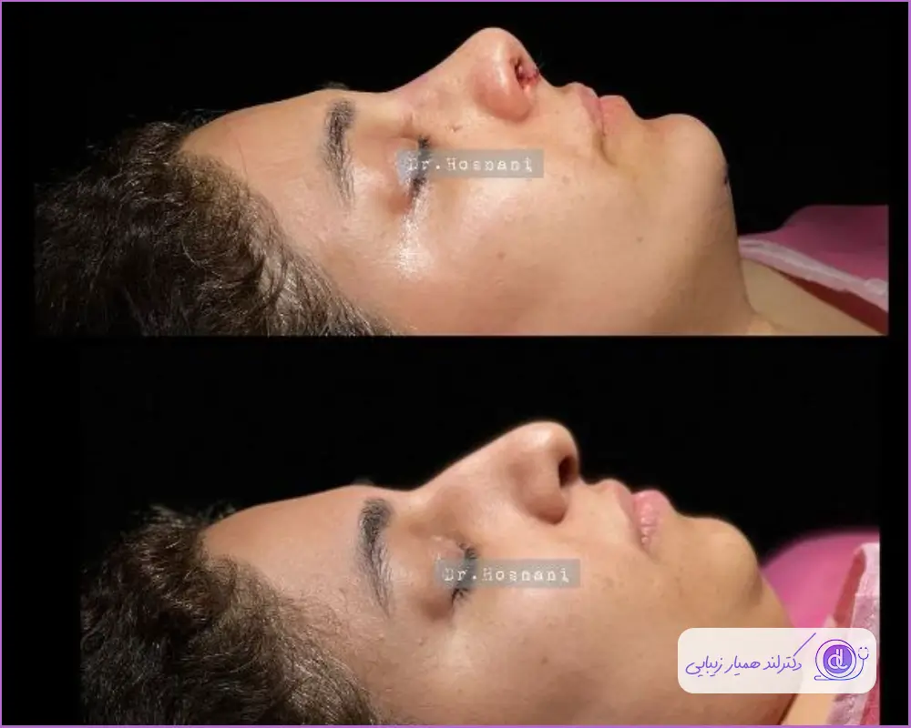 قبل و بعد جراحی زیبایی دماغ گوشتی مدل فانتزی دکتر حمیدرضا حسنانی