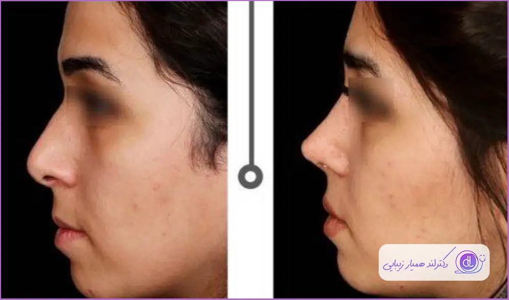 قبل و بعد جراحی بینی به سبک طبیعی زنانه دکتر حسین ابدالی
