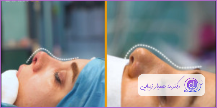 قبل و بعد جراحی بینی گوشتی نیمه فانتزی زنانه دکتر جواد یزدانی