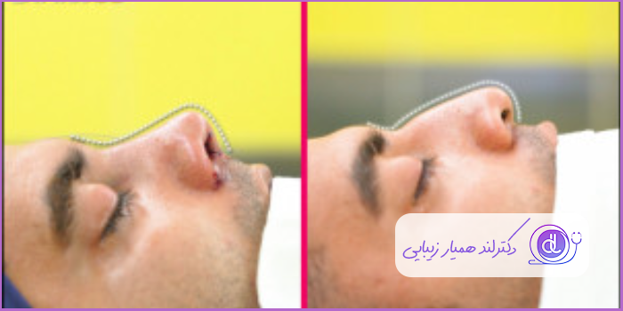 قبل و بعد عمل زیبایی دماغ استخوانی طبیعی مردانه دکتر جواد یزدانی