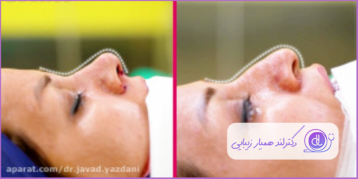 قبل و بعد عمل جراحی بینی گوشتی طبیعی زنانه دکتر جواد یزدانی