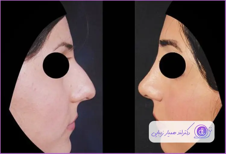 قبل و بعد رینوپلاستی بینی استخوانی طبیعی زنانه دکتر کتایون انصاری