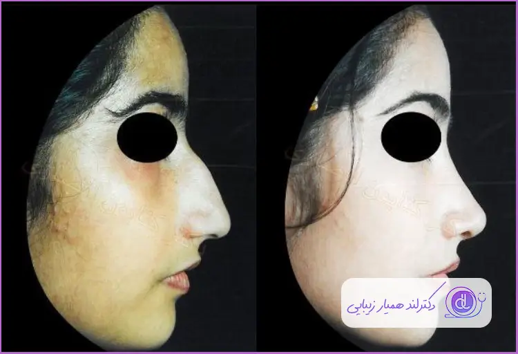قبل و بعد جراحی بینی استخوانی طبیعی دخترانه دکتر کتایون انصاری