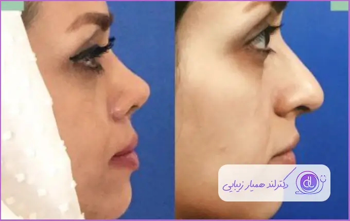 نمونه قبل و بعد عمل زیبایی بینی گوشتی دکتر ملیحه اکبرپور