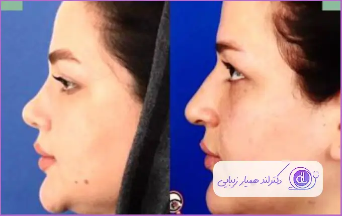 قبل و بعد جراحی بینی گوشتی زنانه دکتر ملیحه اکبرپور