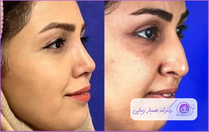 جراحی زیبایی بینی استخوانی دکتر ملیحه اکبرپور
