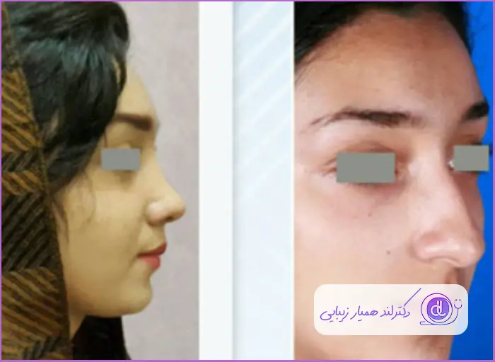 قبل و بعد جراحی زیبایی بینی استخوانی طبیعی دخترانه دکتر مریم تهرانی